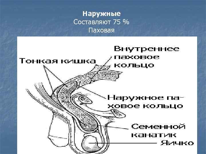 Наружные Составляют 75 % Паховая 