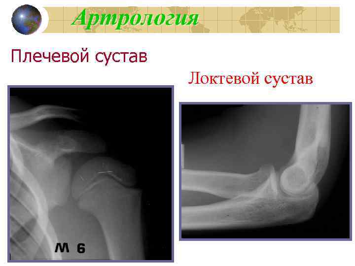Артрология Плечевой сустав Локтевой сустав 