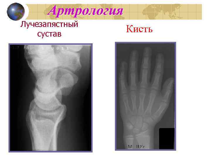 Артрология Лучезапястный сустав Кисть 