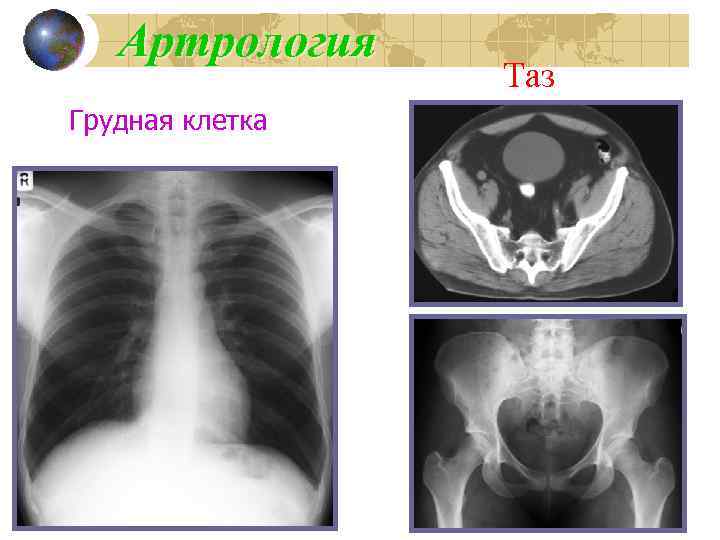 Артрология Грудная клетка Таз 