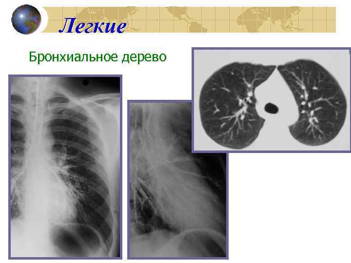Легкие Бронхиальное дерево 