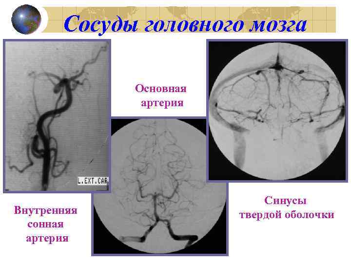 Сосуды головного мозга Основная артерия Внутренняя сонная артерия Синусы твердой оболочки 