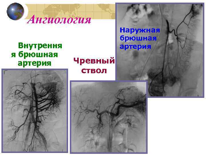 Ангиология Внутрення я брюшная артерия Чревный ствол Наружная брюшная артерия 