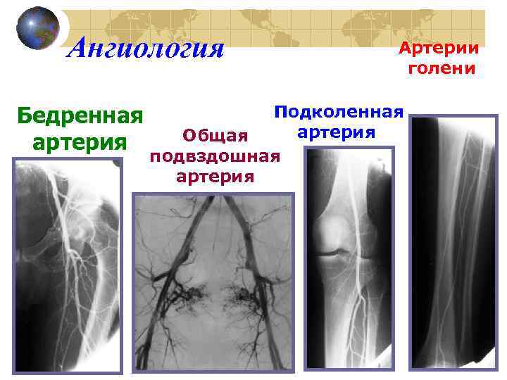 Ангиология Бедренная артерия Артерии голени Подколенная артерия Общая подвздошная артерия 