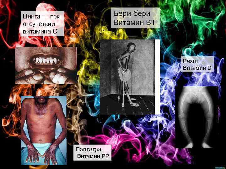 Бери-бери Витамин B 1 Цинга — при отсутствии витамина С Рахит Витамин D Пеллагра