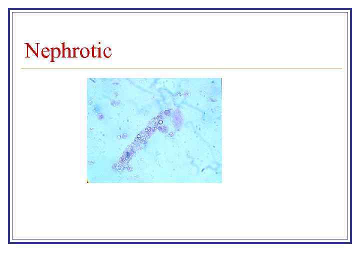 Nephrotic 