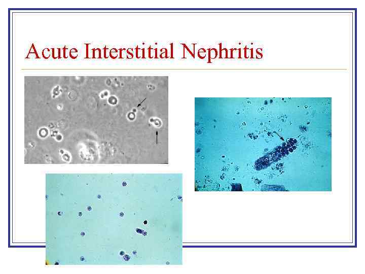 Acute Interstitial Nephritis 