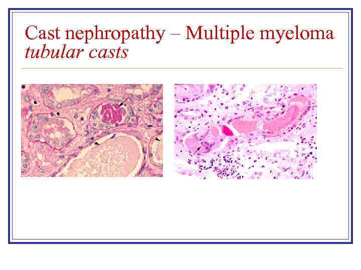 Cast nephropathy – Multiple myeloma tubular casts 