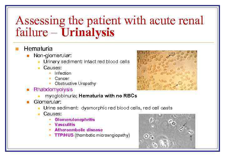 Assessing the patient with acute renal failure – Urinalysis n Hematuria n Non-glomerular: n