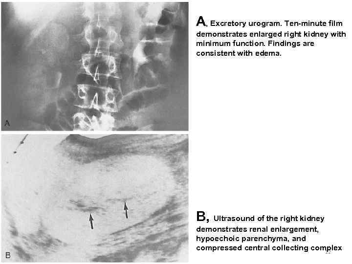 A, Excretory urogram. Ten-minute film demonstrates enlarged right kidney with minimum function. Findings are