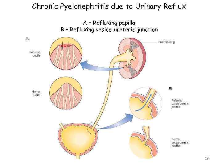 Chronic Pyelonephritis due to Urinary Reflux A – Refluxing papilla B – Refluxing vesico-ureteric