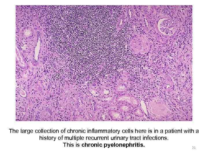 The large collection of chronic inflammatory cells here is in a patient with a