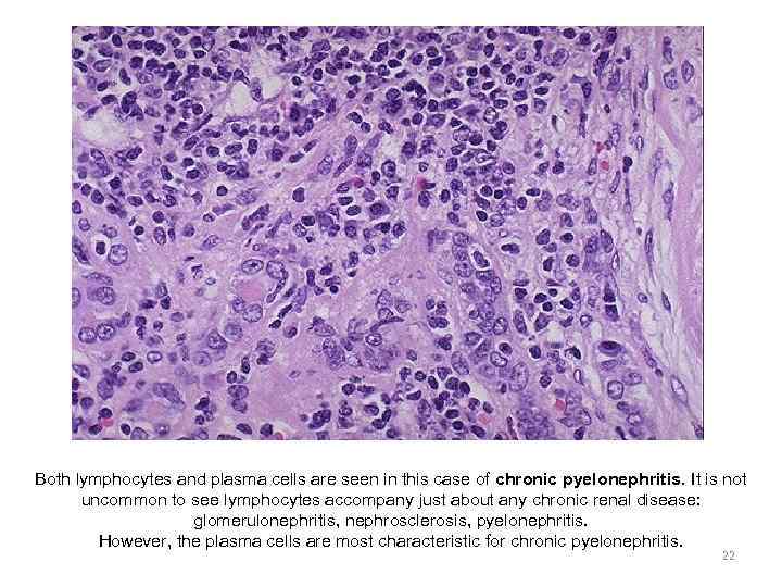 Both lymphocytes and plasma cells are seen in this case of chronic pyelonephritis. It