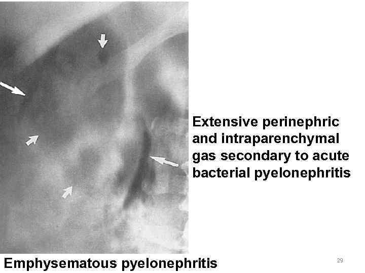 Extensive perinephric and intraparenchymal gas secondary to acute bacterial pyelonephritis Emphysematous pyelonephritis 29 