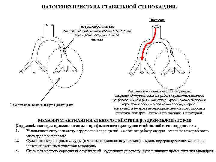 ПАТОГЕНЕЗ ПРИСТУПА СТАБИЛЬНОЙ СТЕНОКАРДИИ. Нагрузка Атеросклеротическая бляшка: гладкие мышцы сосудистой стенки замещаются соединительной тканью