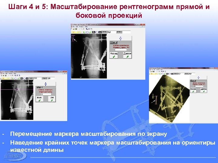 Шаги 4 и 5: Масштабирование рентгенограмм прямой и боковой проекций - Перемещение маркера масштабирования