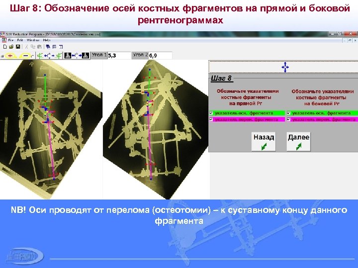 Шаг 8: Обозначение осей костных фрагментов на прямой и боковой рентгенограммах NB! Оси проводят