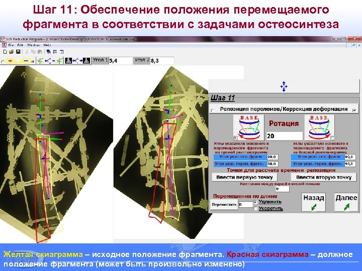 Шаг 11: Обеспечение положения перемещаемого фрагмента в соответствии с задачами остеосинтеза Желтая скиаграмма –