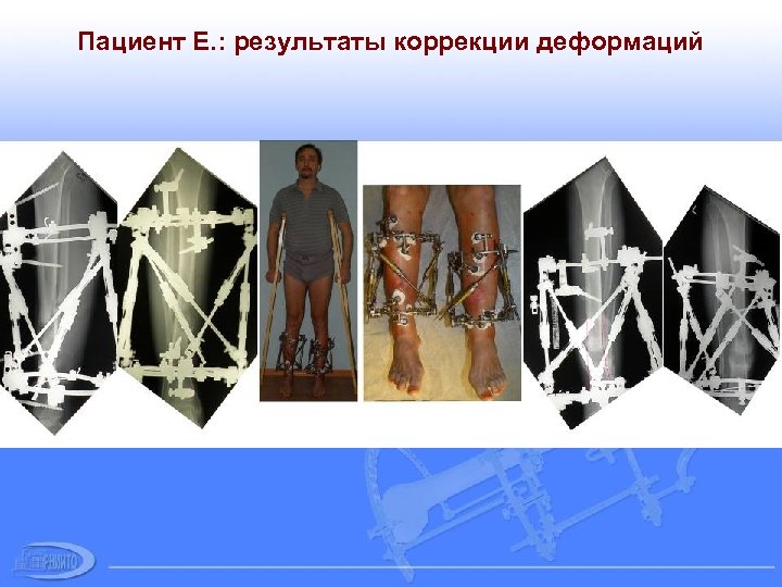 Пациент Е. : результаты коррекции деформаций 