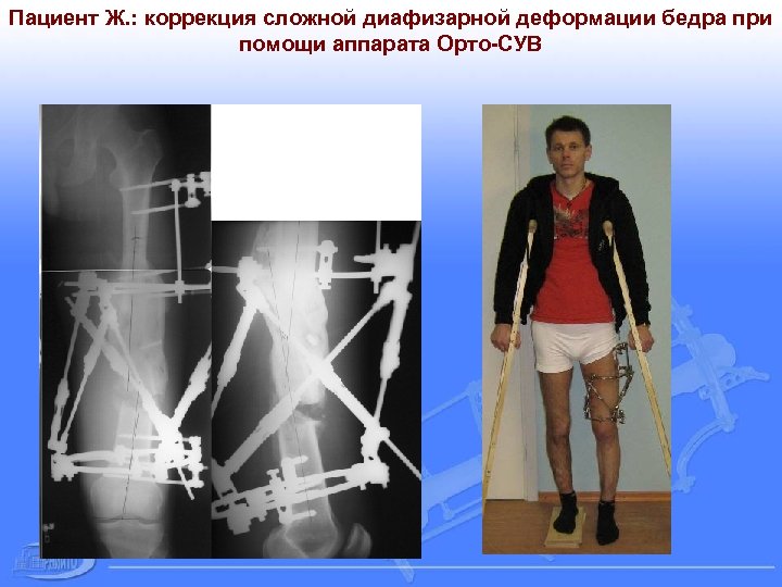 Пациент Ж. : коррекция сложной диафизарной деформации бедра при помощи аппарата Орто-СУВ 