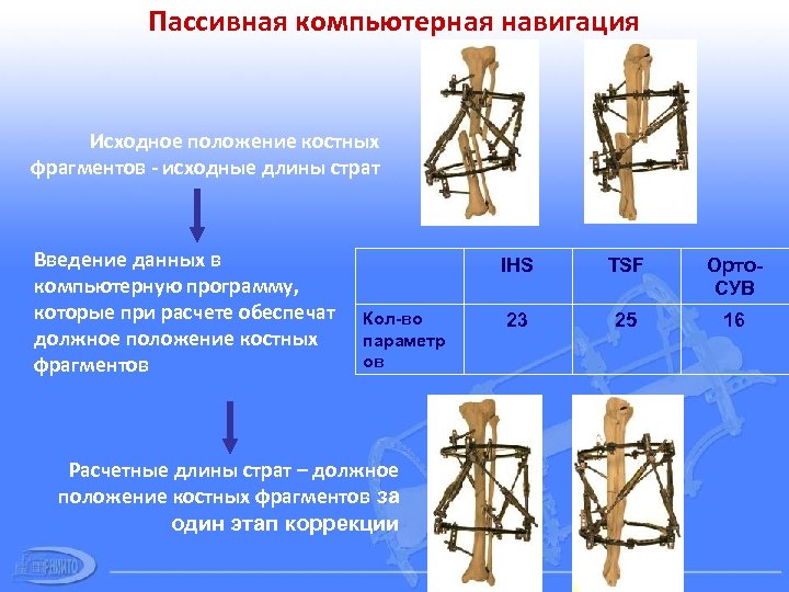 Пассивная компьютерная навигация Исходное положение костных фрагментов - исходные длины страт Введение данных в