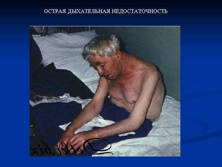 ОСТРАЯ ДЫХАТЕЛЬНАЯ НЕДОСТАТОЧНОСТЬ 
