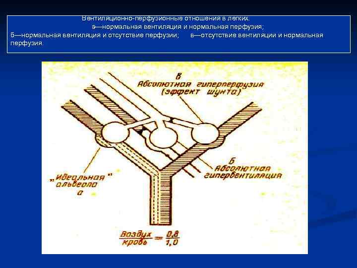 Вентиляционно-перфузионные отношения в легких. а—нормальная вентиляция и нормальная перфузия; б—нормальная вентиляция и отсутствие перфузии;