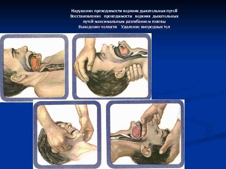 Нарушение проходимости верхних дыхательных путей Восстановление проходимости верхних дыхательных путей максимальным разгибанием головы Выведение