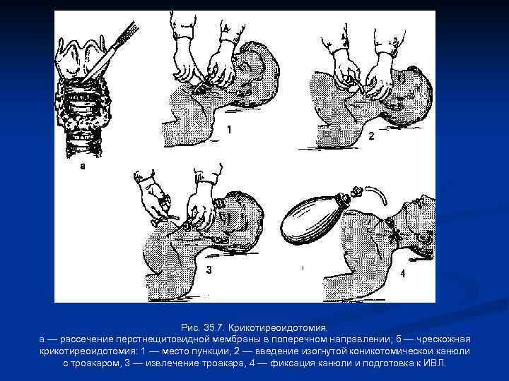 Рис. 35. 7. Крикотиреоидотомия. а — рассечение перстнещитовидной мембраны в поперечном направлении; б —