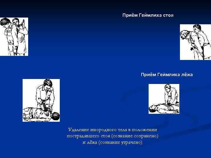 Приём Геймлиха стоя Приём Геймлиха лёжа Удаление инородного тела в положении пострадавшего стоя (сознание