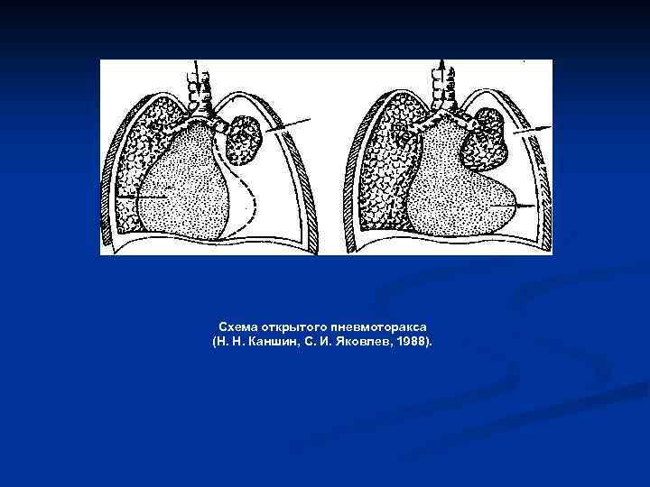 Схема открытого пневмоторакса (Н. Н. Каншин, С. И. Яковлев, 1988). 