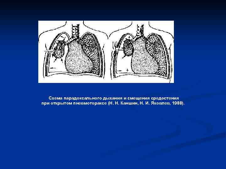 Схема парадоксального дыхания и смещения средостения при открытом пневмотораксе (Н. Н. Каншин, Н. И.