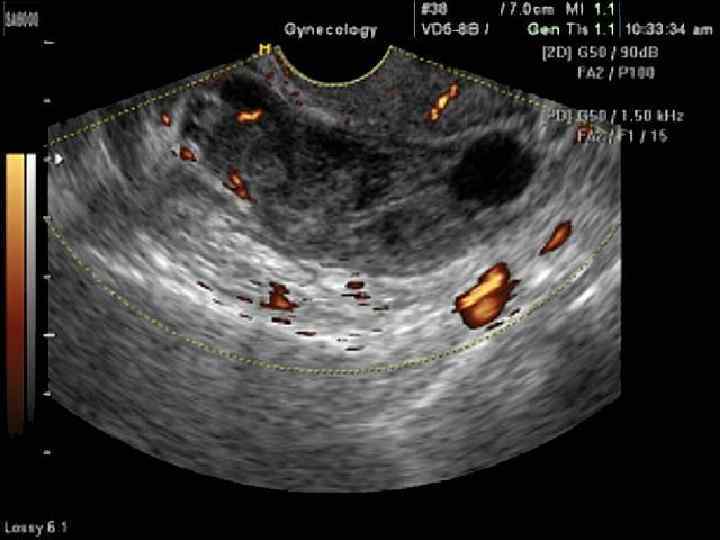 На узи видно внематочную. УЗИ внематочной беременности 5 недель. Ультразвуковое УЗИ внематочную беременность. Внематочная беременность на УЗИ ранний срок беременности. Внематочная беременность на УЗИ на ранних.