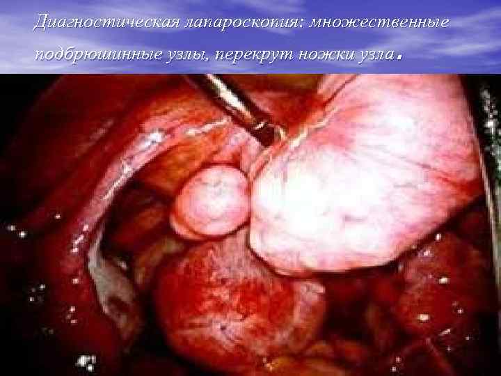 Диагностическая лапароскопия: множественные подбрюшинные узлы, перекрут ножки узла. 