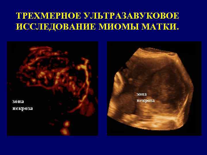 ТРЕХМЕРНОЕ УЛЬТРАЗАВУКОВОЕ ИССЛЕДОВАНИЕ МИОМЫ МАТКИ. зона некроза 