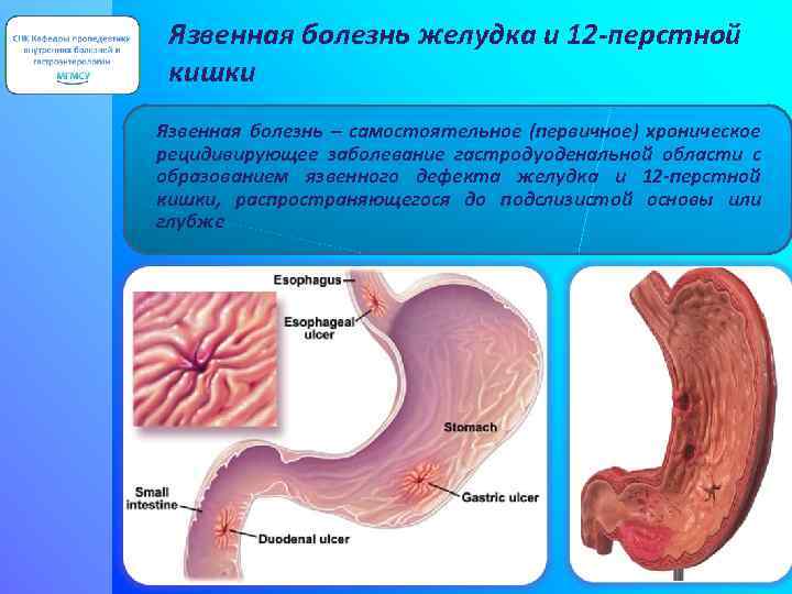 Язвенная болезнь желудка и 12 -перстной кишки Язвенная болезнь – самостоятельное (первичное) хроническое рецидивирующее