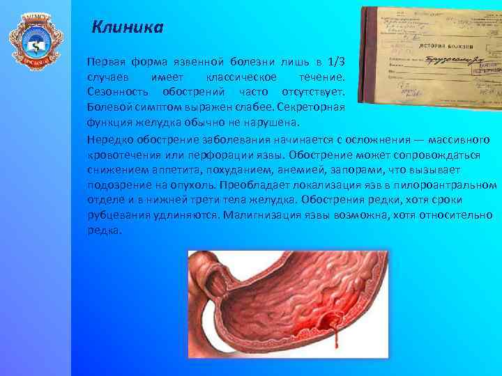 Клиника Первая форма язвенной болезни лишь в 1/3 случаев имеет классическое течение. Сезонность обострений