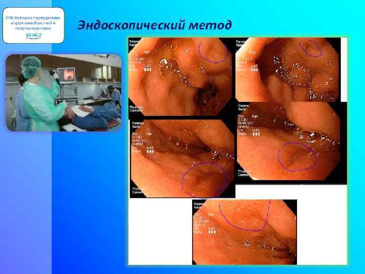 Эндоскопический метод 