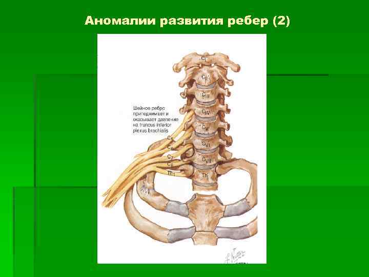 Аномалии развития ребер (2) 