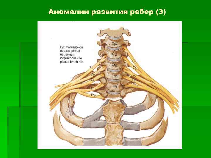 Аномалии развития ребер (3) 