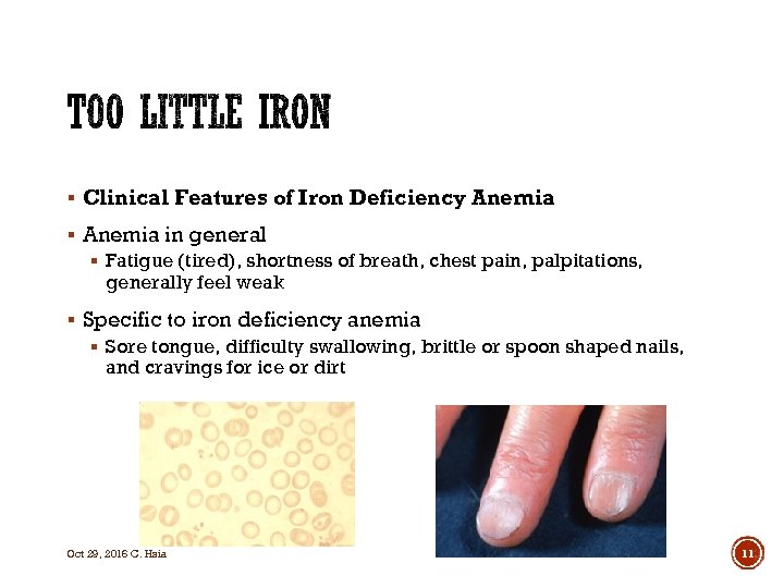 § Clinical Features of Iron Deficiency Anemia § Anemia in general § Fatigue (tired),