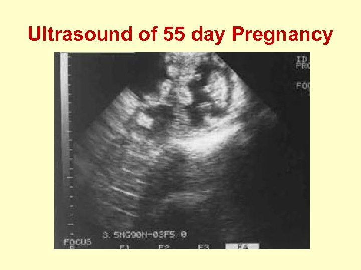 Ultrasound of 55 day Pregnancy 
