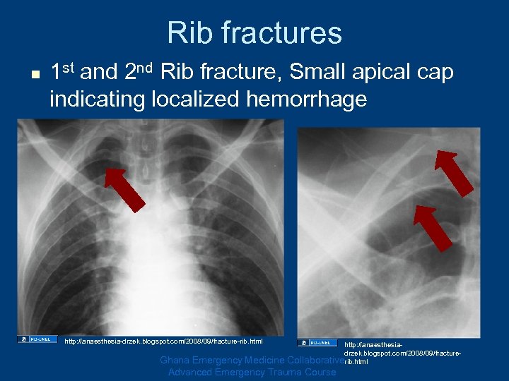 Rib fractures n 1 st and 2 nd Rib fracture, Small apical cap indicating