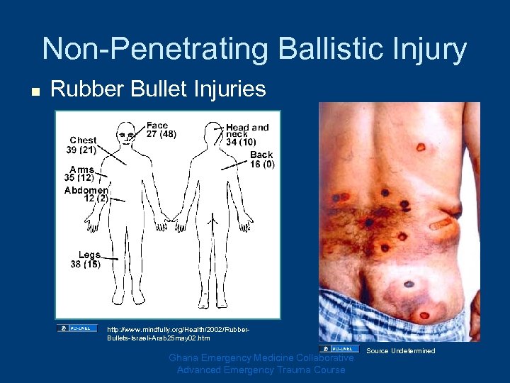 Non-Penetrating Ballistic Injury n Rubber Bullet Injuries http: //www. mindfully. org/Health/2002/Rubber. Bullets-Israeli-Arab 25 may