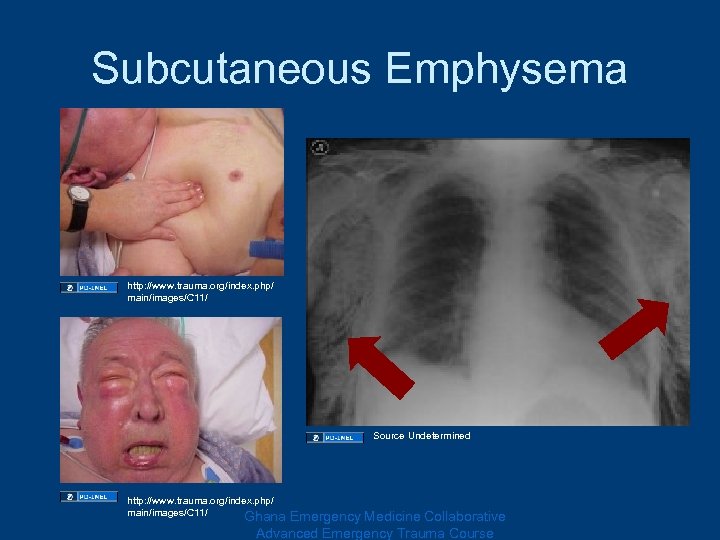 Subcutaneous Emphysema http: //www. trauma. org/index. php/ main/images/C 11/ Source Undetermined http: //www. trauma.