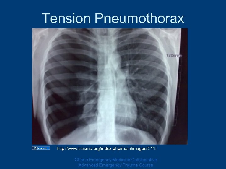 Tension Pneumothorax http: //www. trauma. org/index. php/main/images/C 11/ Ghana Emergency Medicine Collaborative Advanced Emergency