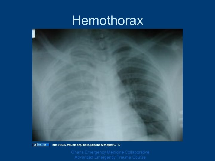 Hemothorax http: //www. trauma. org/index. php/main/images/C 11/ Ghana Emergency Medicine Collaborative Advanced Emergency Trauma