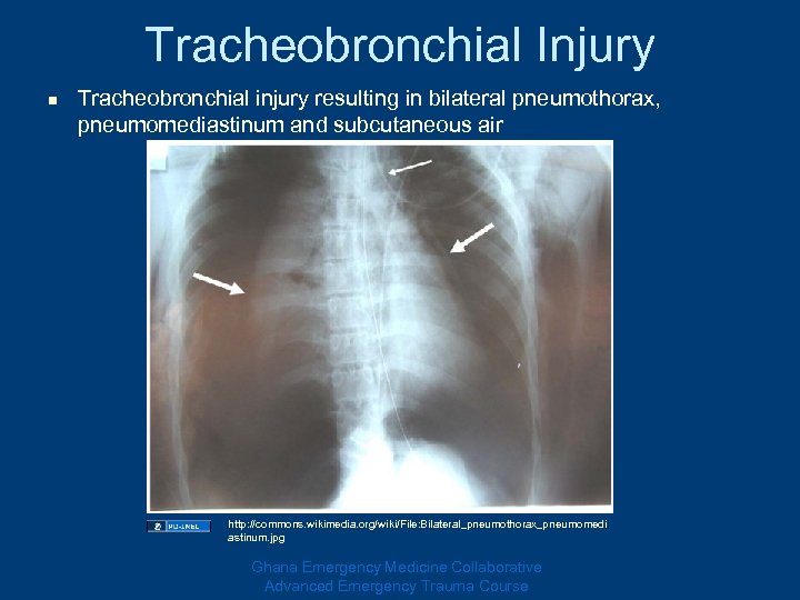 Tracheobronchial Injury n Tracheobronchial injury resulting in bilateral pneumothorax, pneumomediastinum and subcutaneous air http: