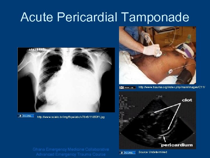 Acute Pericardial Tamponade http: //www. trauma. org/index. php/main/images/C 11/ http: //www. scielo. br/img/fbpe/abc/v 78