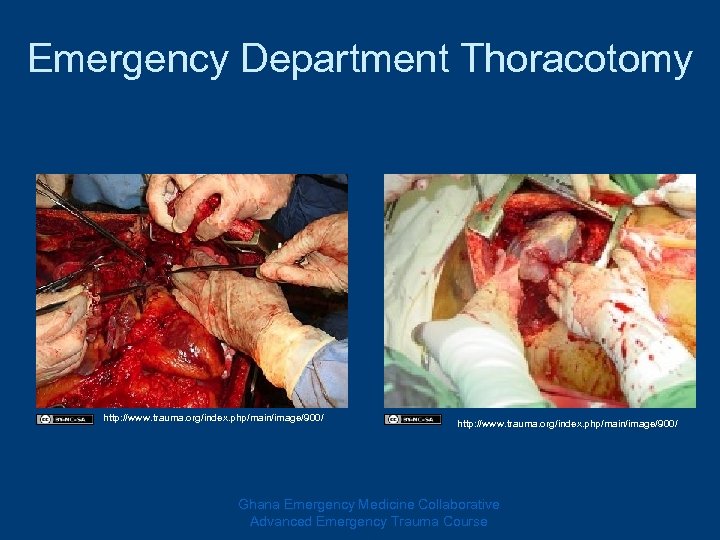 Emergency Department Thoracotomy http: //www. trauma. org/index. php/main/image/900/ Ghana Emergency Medicine Collaborative Advanced Emergency